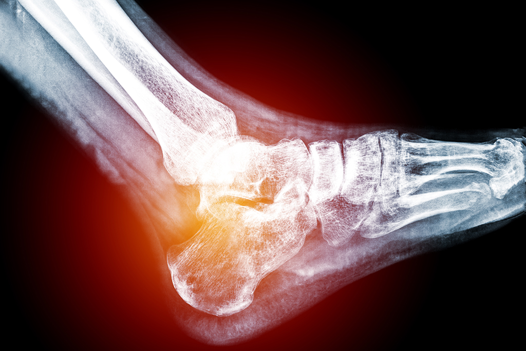 Lateral view of heel of human foot in X-ray (blue on black background), with pains on hell and Calcaneus bone.